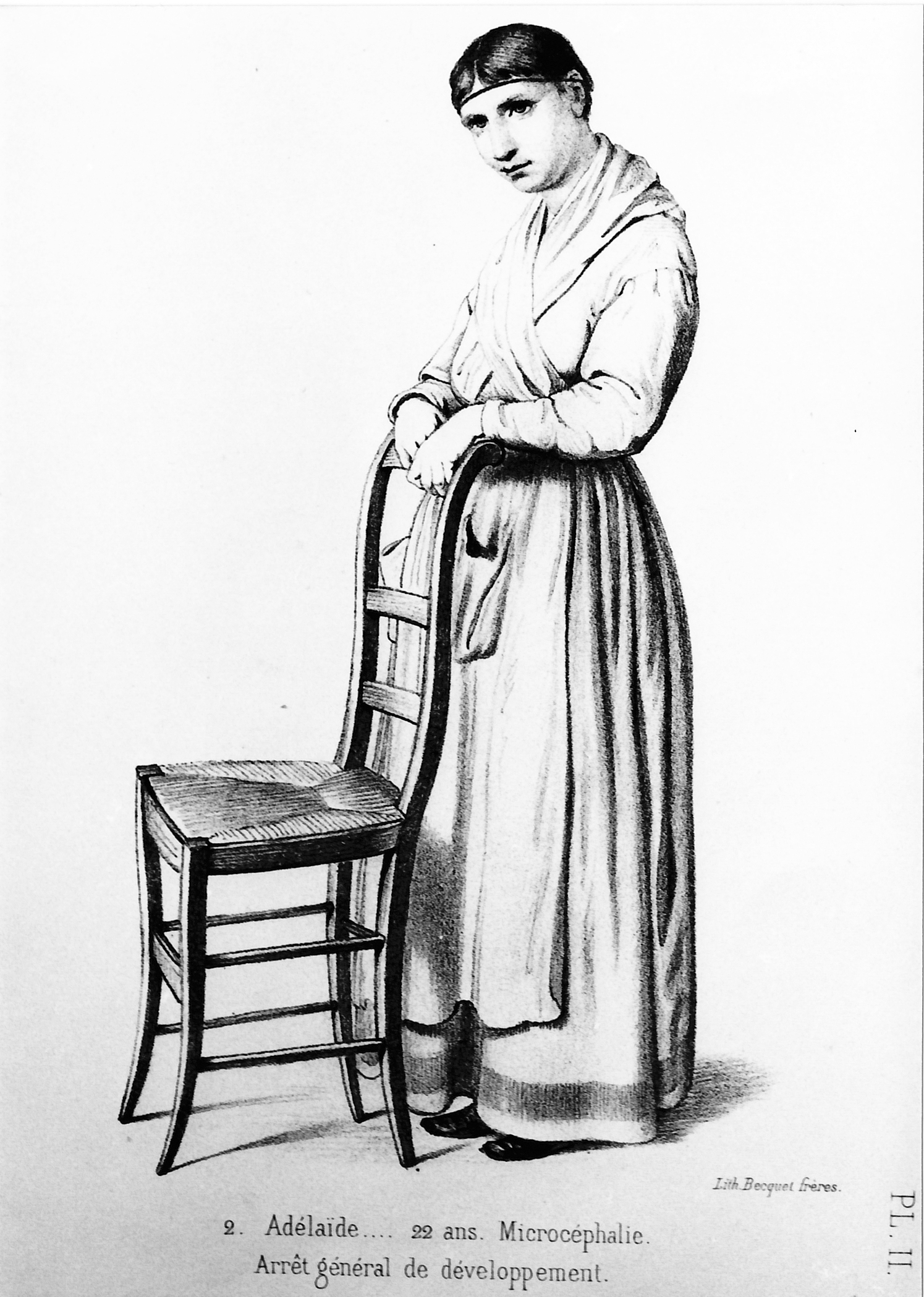 Planche 2 - Figure 2 - Adélaïde, 22 ans. Microcéphalie. Arrêt général de céveloppement. Morel B. A. Traité des dégénérescences. 1857. Atlas Planche II. (2). Lithographie Becquet.