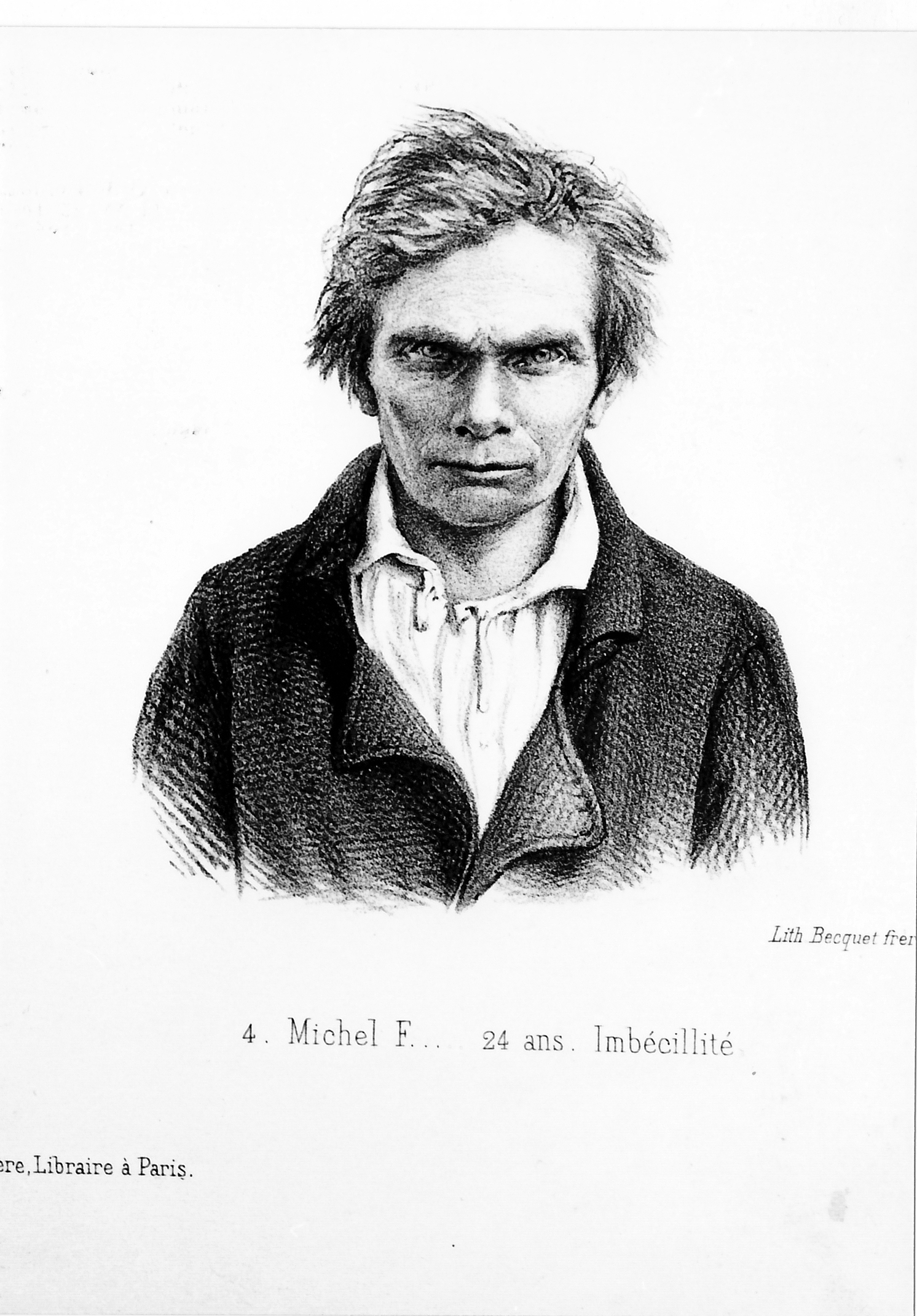 Planche 12 - Figure 4 - Michel F., 24 ans. Imbécillité. Morel B. A. Traité des dégénérescences. 1857. Atlas Planche XII. (4). Lithographie Thorelle del Léveillé.