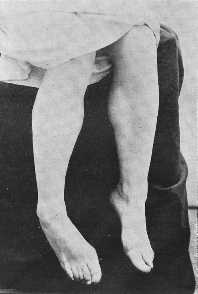 Figure 3.  Contracture du pied droit en varus équin, chez une hystérique He (Raymond et Pierre Janet, (Extrait de Névroses et idées fixes, F. Alcan, 1898, t. II, p. 444.), figure communiquée par M/ F. Alcan.