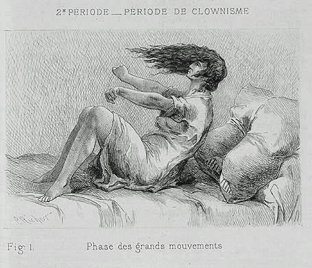 Période de Clownisme; Fig.2 Phase des contorsions (Arc de cercle); A. Delahaye et E. Lecrosnier . Paul Richer. Études Cliniques sur la Grande Hystérie ou Hystéro-Épilepsie. Paris, Octave Doin 1885, 