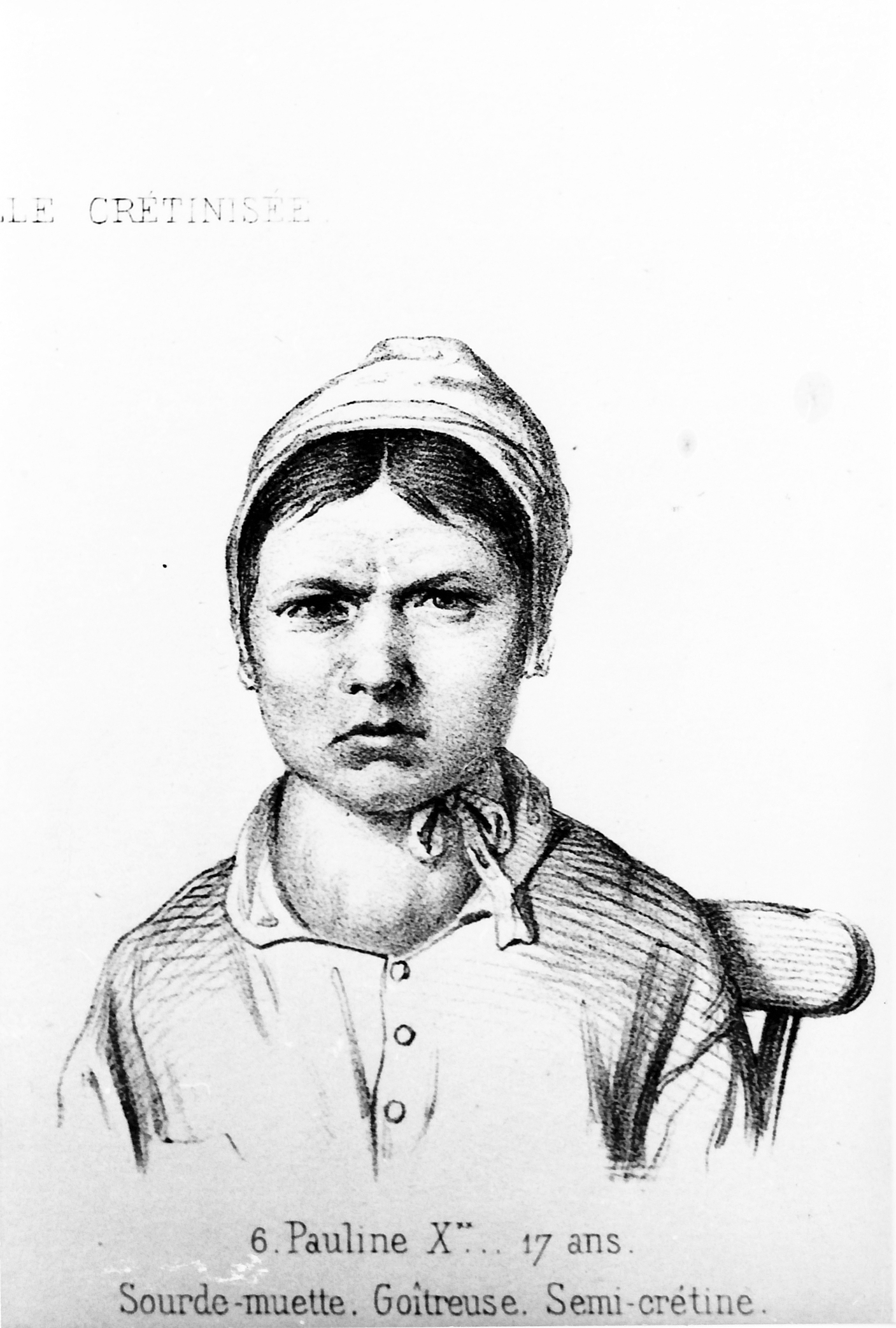 Planche 5 - Figure 2 - Pauline X**, 17 ans. Sourde-Muette. Goîtreuse. Semi-crétine. Morel B. A. Traité des dégénérescences. 1857. Atlas. Planche V. (2). Lithographie Becquet