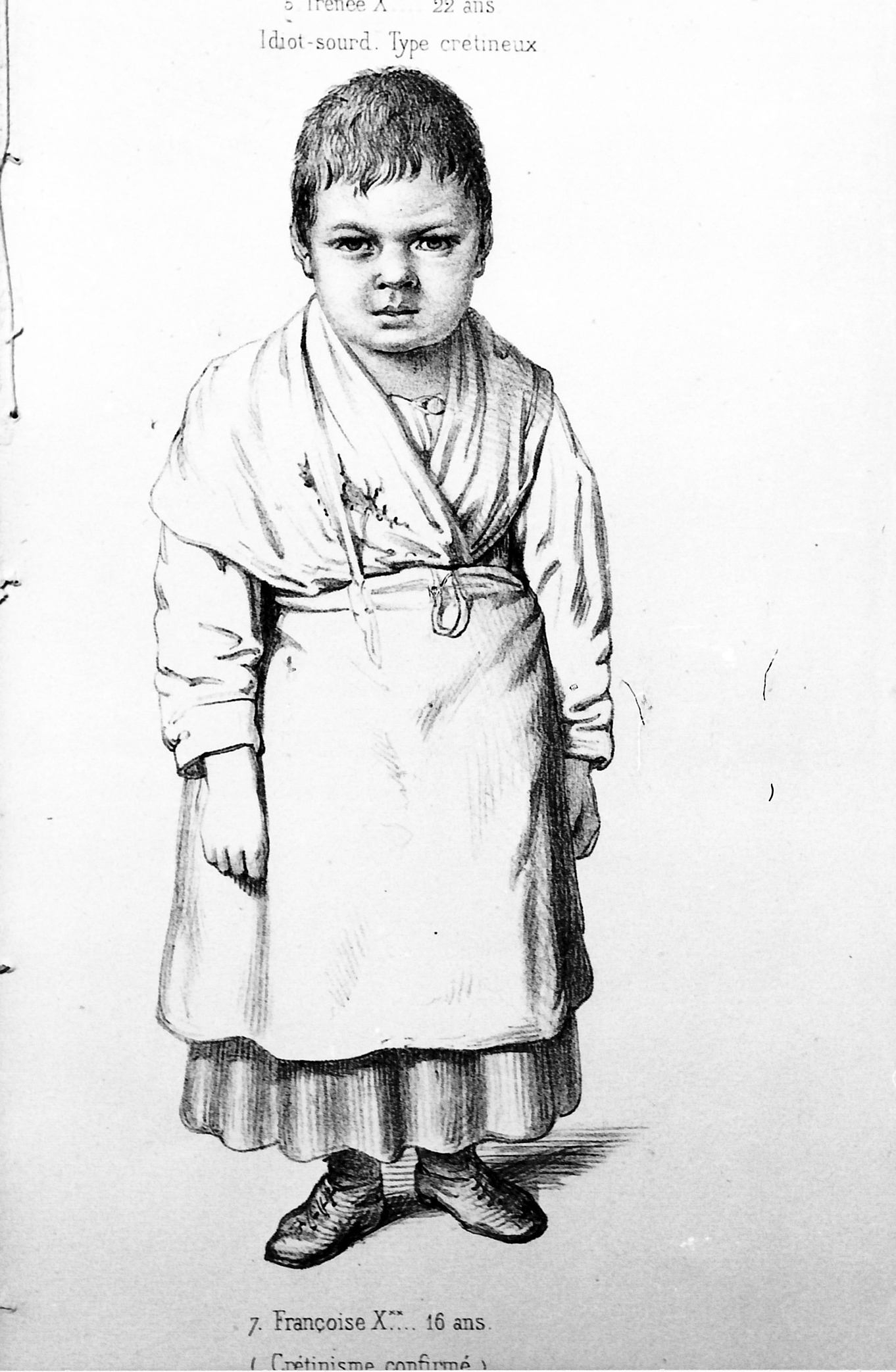 Planche 5 - Figure 3 - Françoise X**, 16 ans. Crétinisme confirmée. Morel B. A. Traité des dégénérescences. 1857. Atlas. Planche V. (3). Lithographie Becquet.