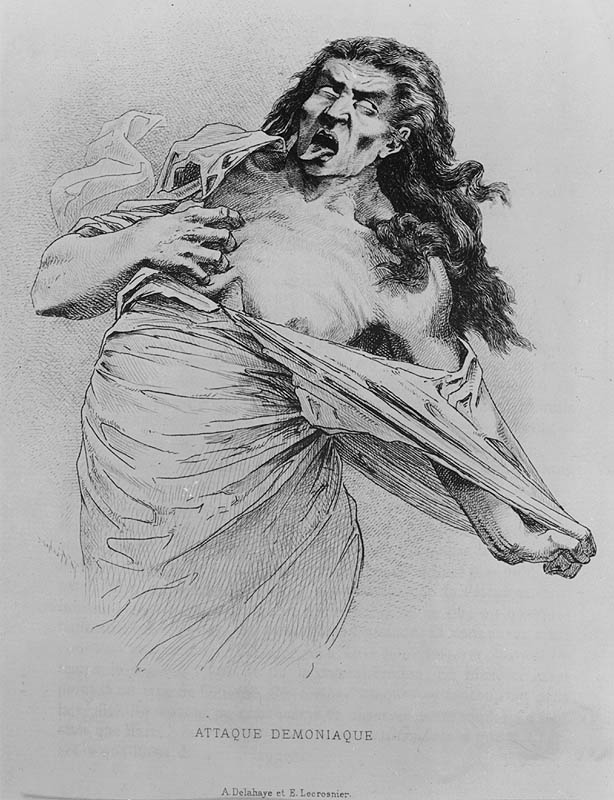 Attaque Demoniaque; A. Delahaye et E. Lecrosnier. Paul Richer. Études Cliniques sur la Grande Hystérie ou Hystéro-Épilepsie. Paris - Octave Doin, 1885.