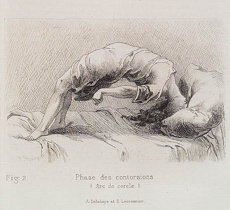 Période de Clownisme; Fig.2 Phase des contorsions (Arc de cercle); A. Delahaye et E. Lecrosnier. P Richer. Études Cliniques sur la Grande Hystérie ou Hystéro-Épilepsie. Paris, Octave Doin 1885.